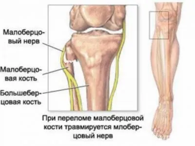 Нейропатія малогомілкового (великогомілкової) нерва симптоми і лікування (нерва) Нейропатія малогомілкового (великогомілкової) нерва симптоми і лікування