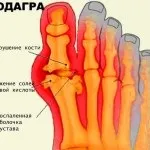 Операція при подагрі видалення шишки на ногах (видалення) Операція при подагрі видалення шишки на ногах