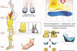 Операція при плоскостопості