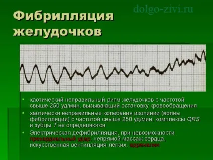 Чи небезпечна екстрасистолія позачергове скорочення загрожує насосної функції серця (небезпечна) Чи небезпечна екстрасистолія позачергове скорочення загрожує насосної функції серця