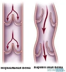 Опухають ноги причини, в районі щиколотки, внизу, у літньої людини, лікування народними засобами (опухають) Опухають ноги причини, в районі щиколотки, внизу, у літньої людини, лікування народними засобами