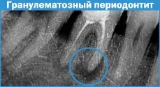 Гострий і хронічний періодонтит, симптоми і класифікація (періодонтит) Гострий і хронічний періодонтит, симптоми і класифікація