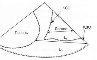 Визначення обсягу плеврального випоту (обсягу) Визначення обсягу плеврального випоту