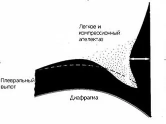 Визначення обсягу плеврального випоту (обсягу) Визначення обсягу плеврального випоту