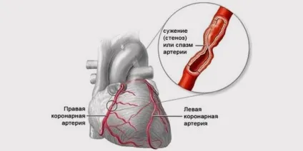 Гостра коронарна недостатність причини, симптоми і лікування синдрому (напад) Гостра коронарна недостатність причини, симптоми і лікування синдрому
