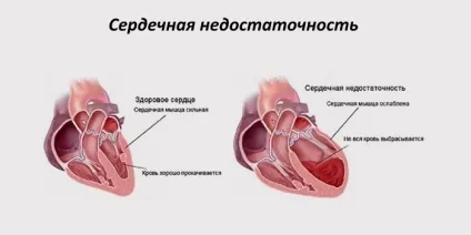 Гостра коронарна недостатність причини, симптоми і лікування синдрому (причини) Гостра коронарна недостатність причини, симптоми і лікування синдрому