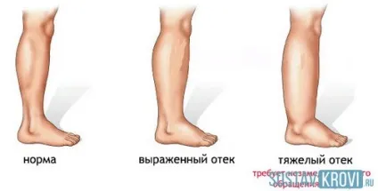Опухають ноги причини, в районі щиколотки, внизу, у літньої людини, лікування народними засобами (районі) Опухають ноги причини, в районі щиколотки, внизу, у літньої людини, лікування народними засобами