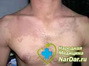 Висівковий лишай оцет - захворювання шкіри - каталог статей - народні лікарські рецепти (висівковий) Висівковий лишай оцет - захворювання шкіри - каталог статей - народні лікарські рецепти