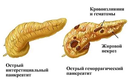 Набряклий панкреатит клінічні ознаки і принципи терапії (набряклий) Набряклий панкреатит клінічні ознаки і принципи терапії