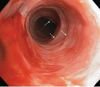 Пептичний рефлюкс-езофагіт 1 ступеня що це таке, симптоми, лікування (пептический) Пептичний рефлюкс-езофагіт 1 ступеня що це таке, симптоми, лікування