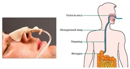 Пептичної езофагіт стадії і причини розвитку запалення (розвитку) Пептичної езофагіт стадії і причини розвитку запалення
