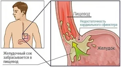Пептичної езофагіт стадії і причини розвитку запалення (езофагіт) Пептичної езофагіт стадії і причини розвитку запалення