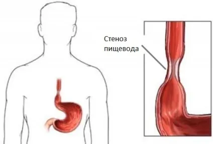 Пептичної езофагіт стадії і причини розвитку запалення (стадії) Пептичної езофагіт стадії і причини розвитку запалення