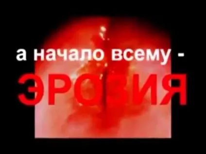Припікання ерозії шийки матки струмом, радіохвилями наслідки, виділення, кровотечі (ерозії) Припікання ерозії шийки матки струмом, радіохвилями наслідки, виділення, кровотечі