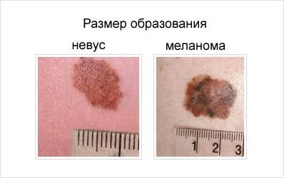 Пігментна меланома розвиток з невусів, симптоми (розвиток) Пігментна меланома розвиток з невусів, симптоми