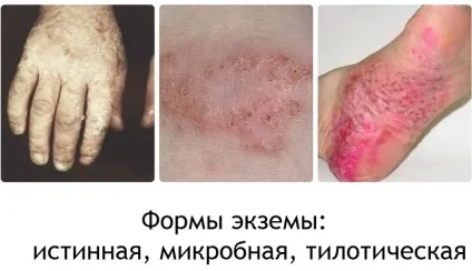 Перші симптоми і ознаки екземи (екземи) Перші симптоми і ознаки екземи