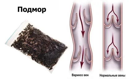 Підмор в лікуванні варикозу