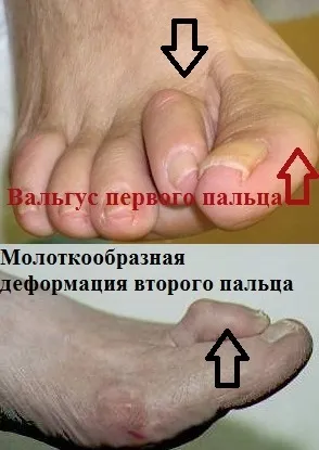 Поперечна плоскостопість симптоми і лікування в Москві, оперативне лікування hallux valgus в москві (лікування) Поперечна плоскостопість симптоми і лікування в Москві, оперативне лікування hallux valgus в москві