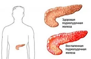 Підшлункова залоза - дієта як ліки меню дієти при хворобі підшлункової залози (меню) Підшлункова залоза - дієта як ліки меню дієти при хворобі підшлункової залози