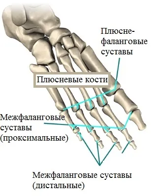 Поперечна плоскостопість симптоми і лікування в Москві, оперативне лікування hallux valgus в москві (поперечна плоскостопість вальгусна деформація першого пальця стопи hallux valgus захворювання лікування Київ Бессараб) Поперечна плоскостопість симптоми і лікування в Москві, оперативне лікування hallux valgus в москві