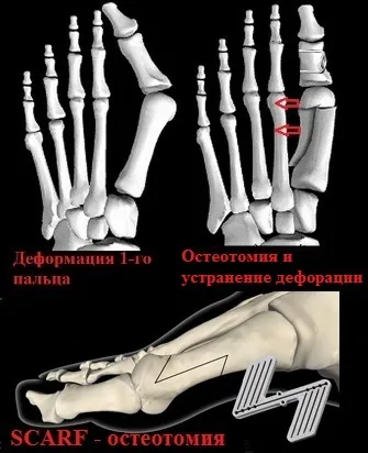 Поперечна плоскостопість симптоми і лікування в Москві, оперативне лікування hallux valgus в москві (поперечна плоскостопість вальгусна деформація першого пальця стопи hallux valgus захворювання лікування Київ Бессараб) Поперечна плоскостопість симптоми і лікування в Москві, оперативне лікування hallux valgus в москві