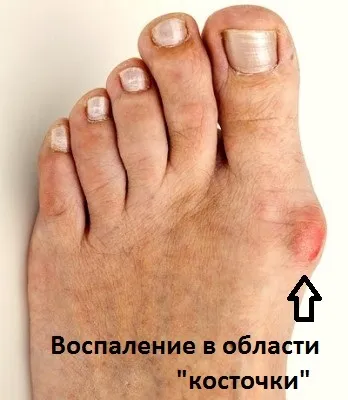 Поперечна плоскостопість симптоми і лікування в Москві, оперативне лікування hallux valgus в москві (поперечне) Поперечна плоскостопість симптоми і лікування в Москві, оперативне лікування hallux valgus в москві