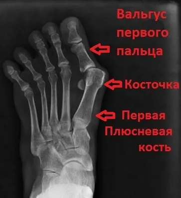 Поперечна плоскостопість симптоми і лікування в Москві, оперативне лікування hallux valgus в москві (оперативне) Поперечна плоскостопість симптоми і лікування в Москві, оперативне лікування hallux valgus в москві