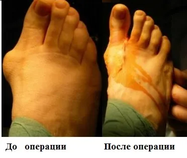 Поперечна плоскостопість симптоми і лікування в Москві, оперативне лікування hallux valgus в москві (плоскостопість) Поперечна плоскостопість симптоми і лікування в Москві, оперативне лікування hallux valgus в москві