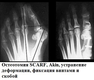 Поперечна плоскостопість симптоми і лікування в Москві, оперативне лікування hallux valgus в москві (плоскостопість) Поперечна плоскостопість симптоми і лікування в Москві, оперативне лікування hallux valgus в москві