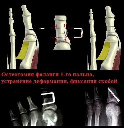 Поперечна плоскостопість симптоми і лікування в Москві, оперативне лікування hallux valgus в москві (поперечне) Поперечна плоскостопість симптоми і лікування в Москві, оперативне лікування hallux valgus в москві