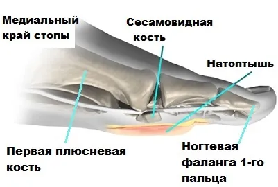 Поперечна плоскостопість симптоми і лікування в Москві, оперативне лікування hallux valgus в москві (плоскостопість) Поперечна плоскостопість симптоми і лікування в Москві, оперативне лікування hallux valgus в москві