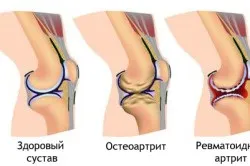 Підвищення імунітету у літніх людей
