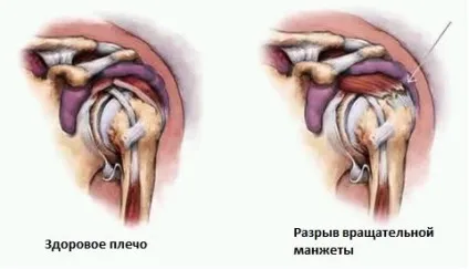 Пошкодження обертальної манжети плеча, симптоми, діагностика, лікування, киев (обертальної) Пошкодження обертальної манжети плеча, симптоми, діагностика, лікування, київ