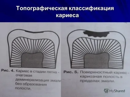 Презентація на тему карієс зубів (карієс зубів. Етіологія і патогенез. Особливості перебігу карієсу в залежності від локалізації вогнища ураження. Тема проекту: Запоріжжя 2012.) Презентація на тему карієс зубів