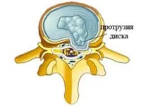 Протрузія міжхребцевих дисків (дифузна, циркулярна, медіанна, форамінальні) (циркулярна) Протрузія міжхребцевих дисків (дифузна, циркулярна, медіанна, форамінальні)