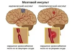 Профілактика інсультів первинна та вторинна, додаткові заходи, вправи (відео та картинки) (додаткові) Профілактика інсультів первинна та вторинна, додаткові заходи, вправи (відео та картинки)