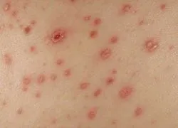 Ознаки вітрянки у дітей