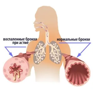 Ознаки бронхіальної астми при кашльовий форми (астми) Ознаки бронхіальної астми при кашльовий форми