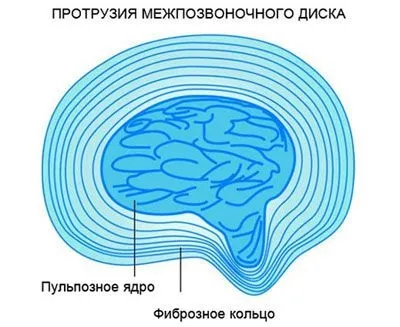Протрузія міжхребцевих дисків (дифузна, циркулярна, медіанна, форамінальні) (дифузна) Протрузія міжхребцевих дисків (дифузна, циркулярна, медіанна, форамінальні)