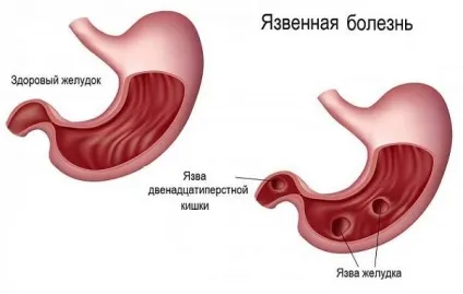 Ознаки виразки шлунка перші симптоми (симптоми) Ознаки виразки шлунка перші симптоми
