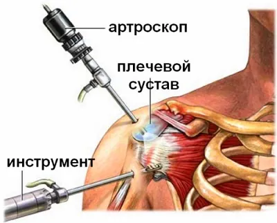 Ротаторна манжета плечового суглоба симптоми травми, ушкодження (суглоба) Ротаторна манжета плечового суглоба симптоми травми, ушкодження