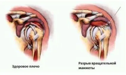 Ротаторна манжета плечового суглоба симптоми травми, ушкодження (манжета) Ротаторна манжета плечового суглоба симптоми травми, ушкодження