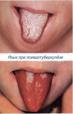 Псевдотуберкульозу форми, причини, симптоми, лікування