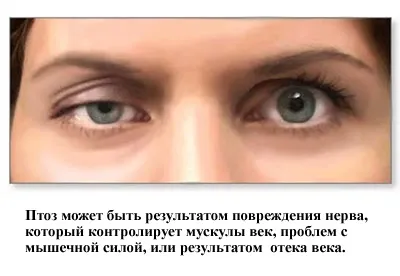 Птоз верхньої повіки причини, симптоми і його лікування (птоз) Птоз верхньої повіки причини, симптоми і його лікування