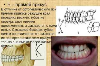 Прямий прикус у людини що це таке, чи такий він правильний, фото пацієнтів (прямий прикус фото) Прямий прикус у людини що це таке, чи такий він правильний, фото пацієнтів