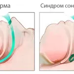 Синдром нічного апное симптоми і лікування розлади (апное) Синдром нічного апное симптоми і лікування розлади