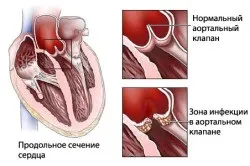 Симптоми інфекційного ендокардиту (симптоми) Симптоми інфекційного ендокардиту