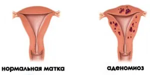 симптоми аденомиоза