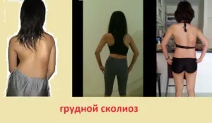 Сколіоз грудного відділу хребта - симптоми, лікування і ЛФК, лівобічний, правобічний (відділу) Сколіоз грудного відділу хребта - симптоми, лікування і ЛФК, лівобічний, правобічний