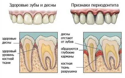 Симптоми і ознаки періодонтиту, діагностика (рентген та інші методи дослідження зубів), в тому (ознаки) Симптоми і ознаки періодонтиту, діагностика (рентген та інші методи дослідження зубів), в тому